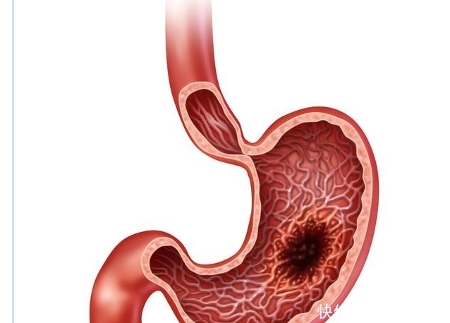  消化不良|胃癌多是“拖”出来的，身体4个小毛病不断出现，是胃在求救！
