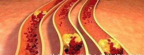 化瘀散结|子宫肌瘤3大形成原因：炎、寒、气！中医1招，化瘀散结，彻底降服