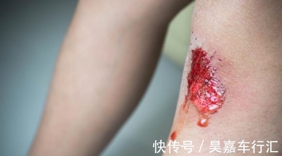 脚部|血脂高不高,看脚就知道,若没有这4种症状,恭喜,血管还算通畅