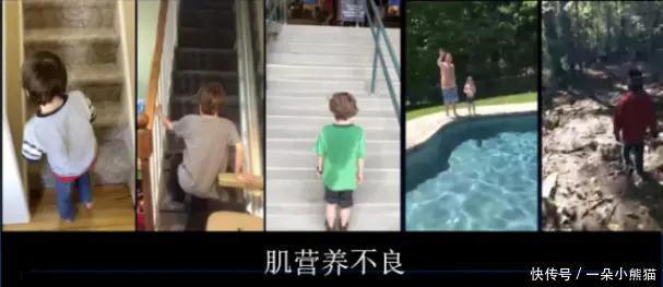 发病|肌营养不良最晚几岁发病?