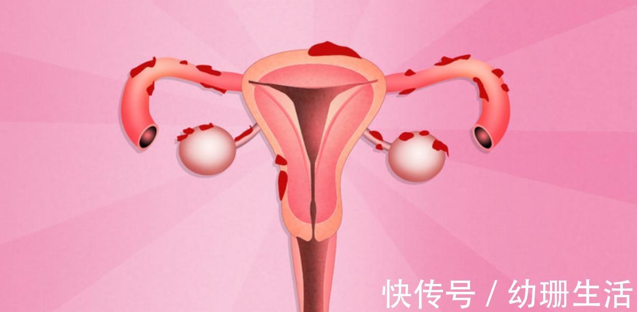 药物治疗|“搞定”子宫肌瘤，3个方法任你选，别一拖再拖