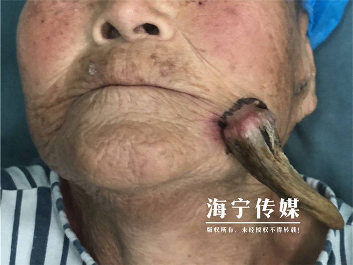 皮角|看着吓人！海宁90岁老太太脸上长出一只长7厘米的“怪角”