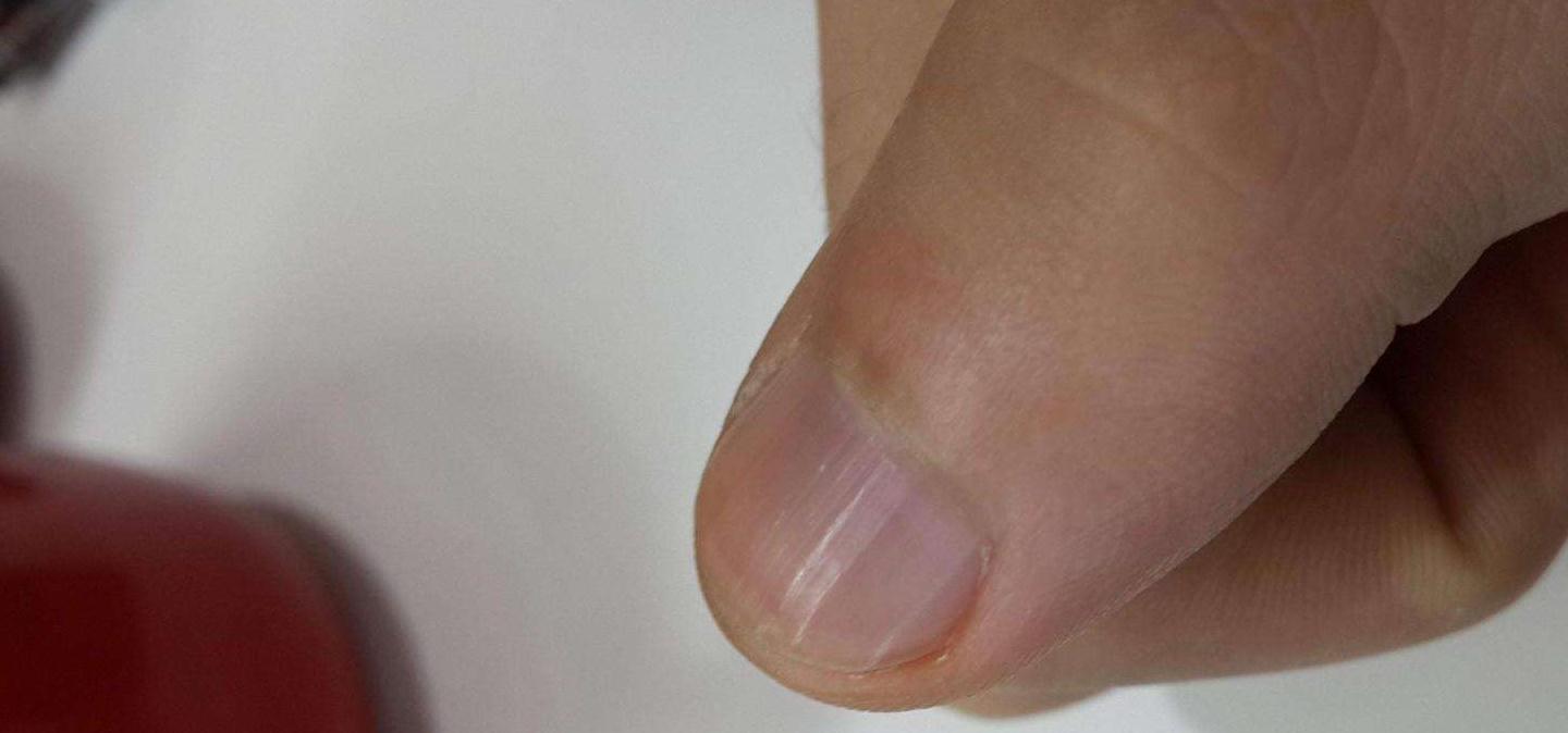 手指甲|不论男女,手指甲有竖纹多吃它,补钙补气血,晚上不失眠