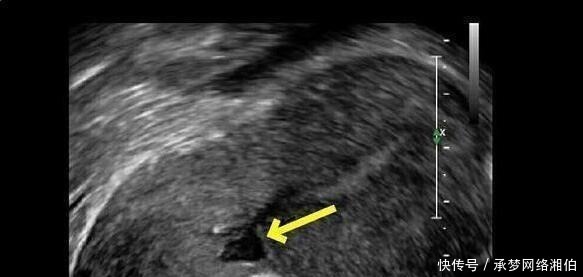 胎盘|剖腹产最多剖几次?第3次剖腹产危险大吗?这些答案孕妇得搞清楚