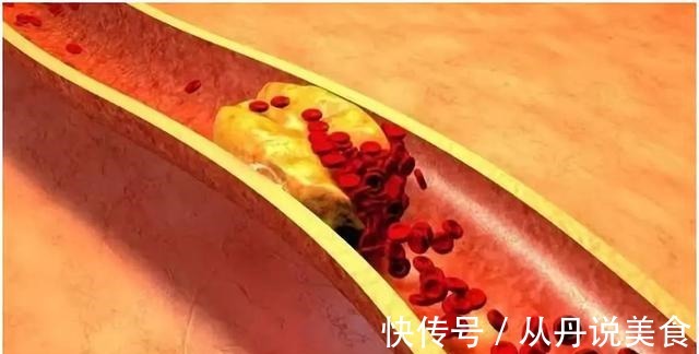 血脂|牛奶会加重高血脂医生若想降脂,吃2物,喝3水,血管或变干净
