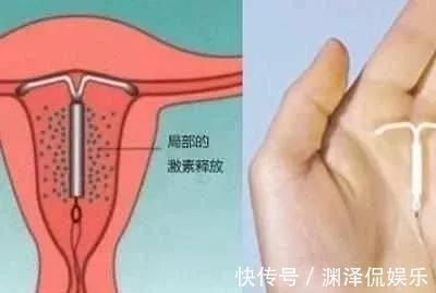 丈夫们|生完后是“上环”好还是“结扎”好医生讲出实话,很多人选错了