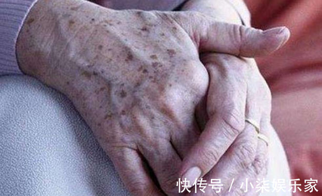 大蒜|老年斑太难看怎么办老奶奶教你3招,淡化20年斑,试过都说好