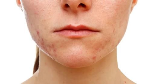 肺部|秋季干燥肺易生病？学会养肺3步法，养肺养生两不误