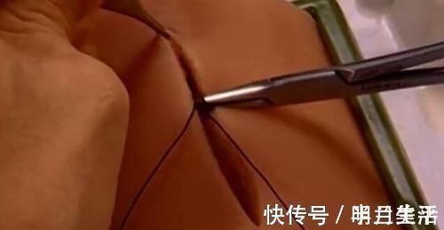 孕产妇|剖腹产是美容线好还是普通线好?区别有3点,产妇早知道早预防