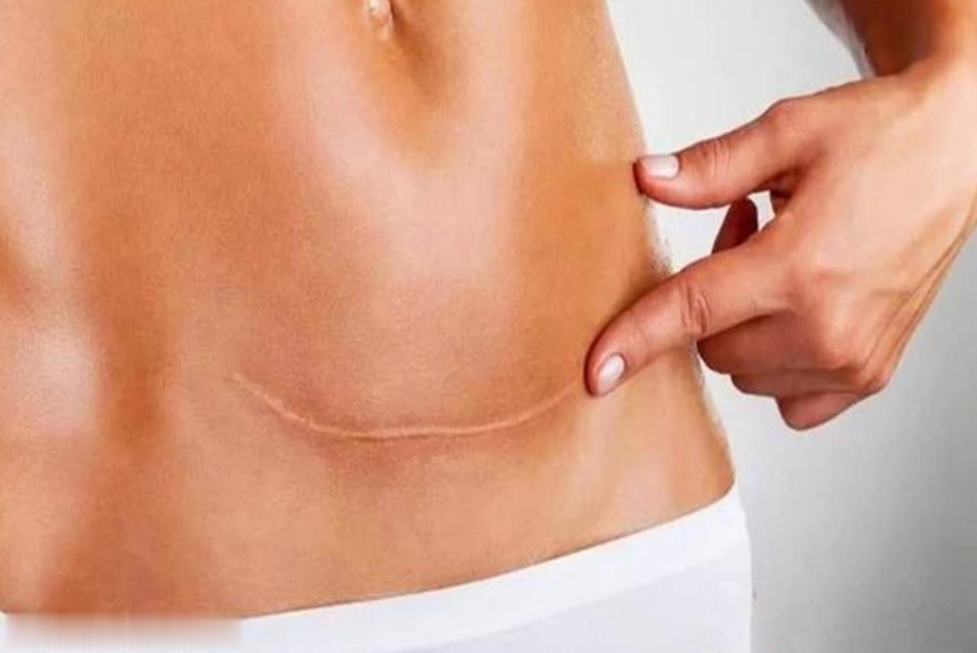 竖刀|“我没说要竖刀啊”,为什么剖腹产医院默认竖刀女性要提前了解