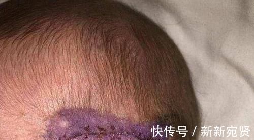 顺产|剖腹产划伤孩子头部,医生很快就会好的,7年后家长找上医院