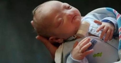 婴儿|“无鼻婴儿”惨遭唾弃，两年后再见宝宝的样子，让人感动羞愧！