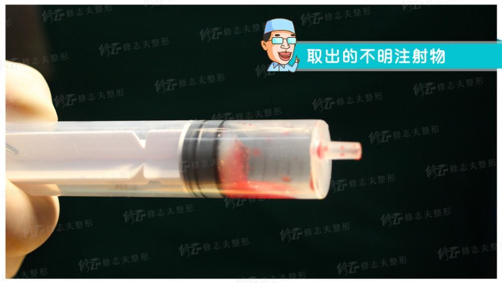  鼻尖|鼻修复时取出的东西都有啥？感受一下！