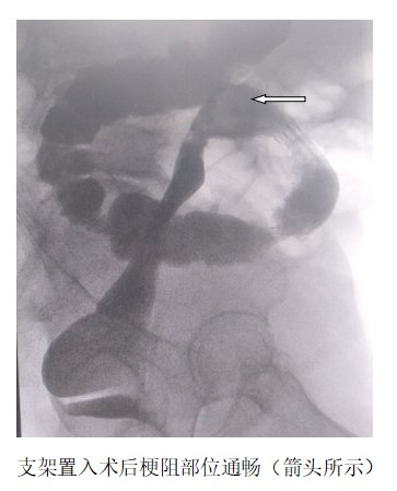 治疗|肠道支架，对抗肠道梗阻的优选