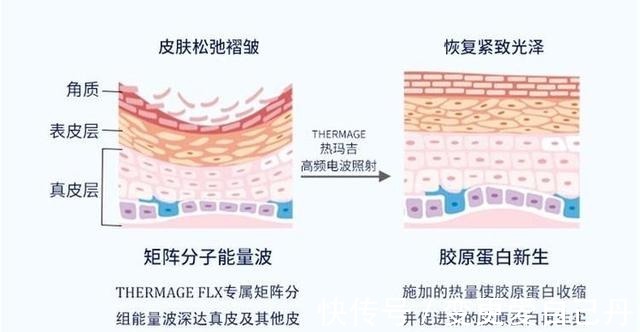 胶原蛋白 盘点热玛吉容易踩的坑!