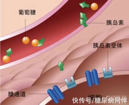 胰岛素|这些糖尿病酮症酸中毒的问题，你有必要了解