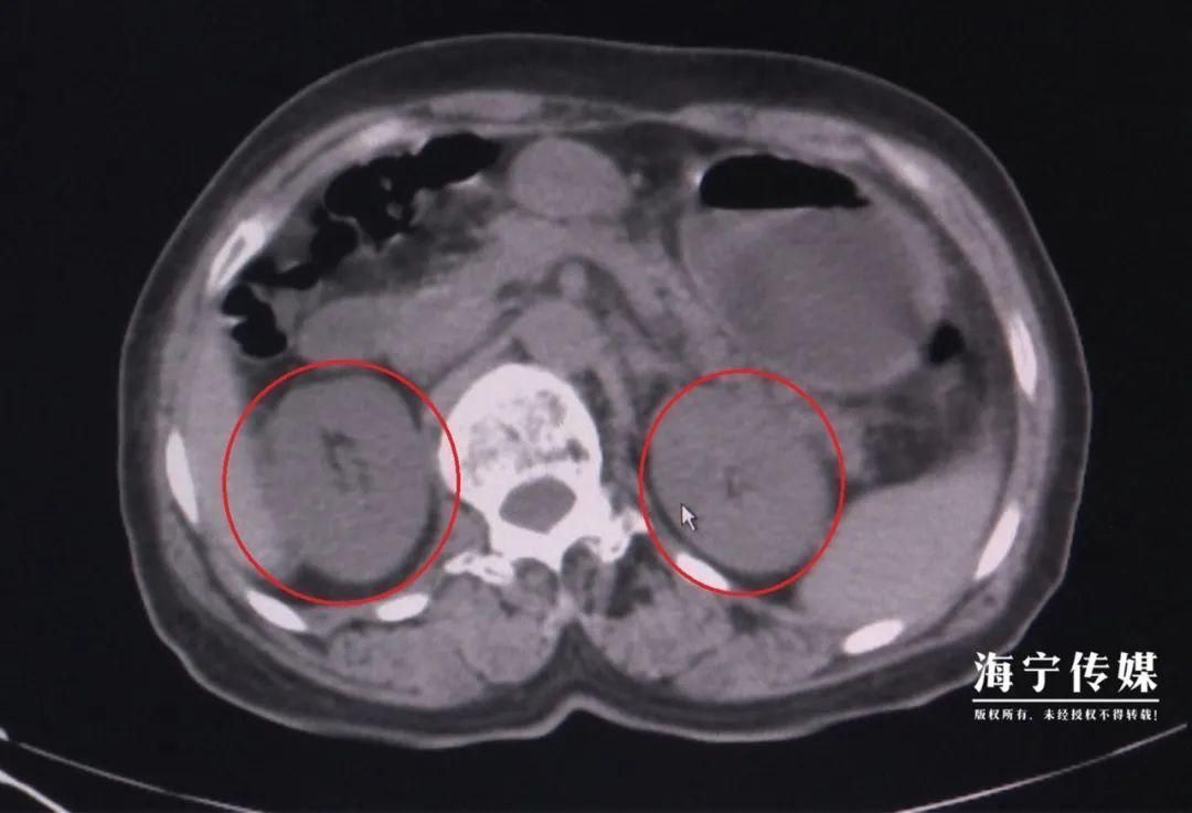 刀豆|吃了一盘家常菜 ,女子三天不排尿,还患上尿毒症!医生提醒:很多人都爱吃