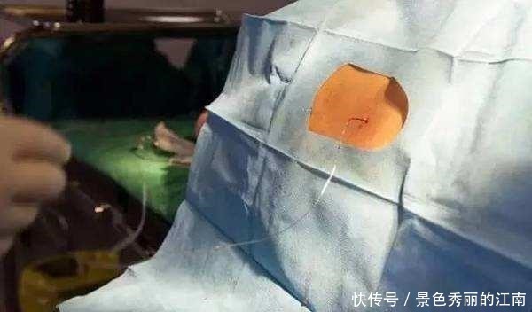 剖腹产|剖腹产麻醉后,产妇有啥感觉,看经历过的妈妈们怎么说