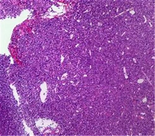 肿瘤细胞|肿瘤一般治不好,能治好的都是误诊了?肿瘤医生说出了心里话