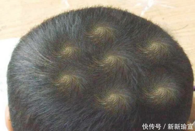 晓雯|孩子头顶上的“两个旋”代表啥?很多父母误解了,看完你就懂了