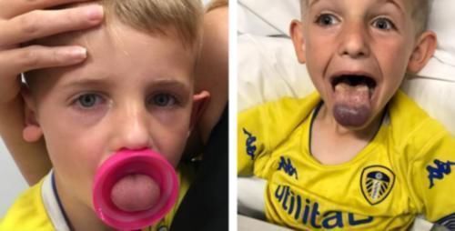 舌头|夹伤舌头的“危险水杯”,你还在用?数名宝宝已中招,家长速查