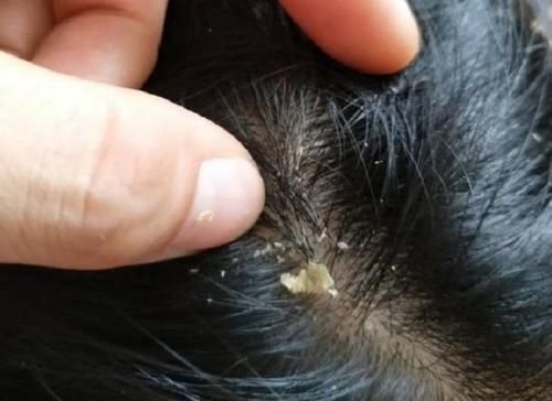 头上抠出白色“颗粒物”?到底是什么?通常离不开“3个原因”!