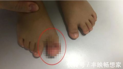 吴德超|得了这病,半岁宝宝脚趾比香蕉还粗!不注意还会复发…