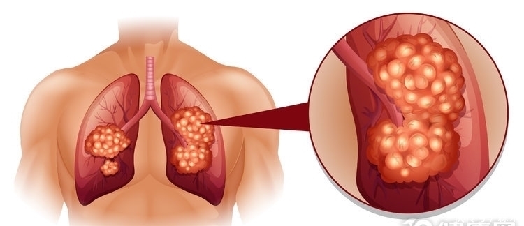 肺癌|肺癌晚期不治疗，能活多长时间？有3个决定因素