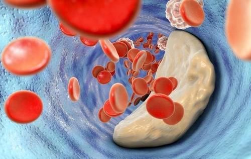 偏高|查出低密度脂蛋白偏高的人，提醒：这些食物建议少吃