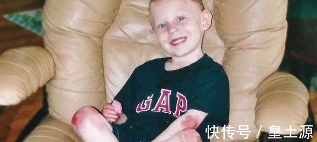 蝴蝶|“蝴蝶儿童”!15岁男孩只要皮肤摩擦就长血泡,连洗澡都成磨难