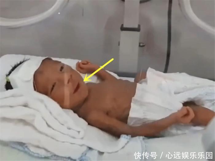 重900克的早产儿,第一次见妈妈就笑了,宝宝的腿却让妈妈泪崩