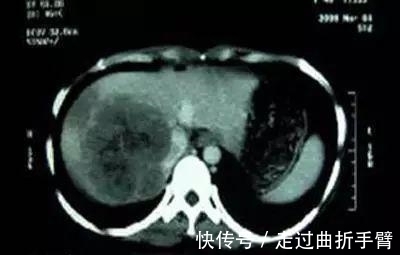 教师|27岁教师肝癌离世! 她的经历告诉你: 一定远离这3个坏习惯!