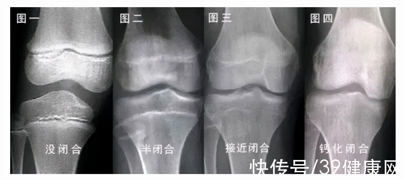 断骨|当年花16万锯断骨头，只为长高7厘米的男孩，现在怎么样了？