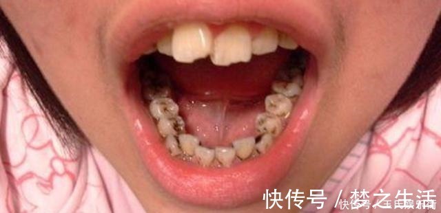 散散步|孩子被嘲笑“嘴太臭”,被同学孤立,医生取出小颗粒,宝妈都嫌臭