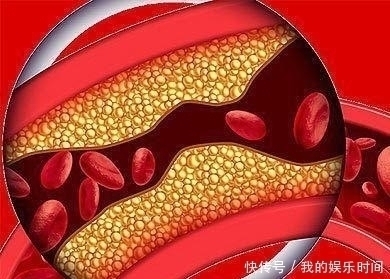 服用阿司匹林|人到中年每天服用阿司匹林,能起到预防颈动脉斑块发生的作用吗?