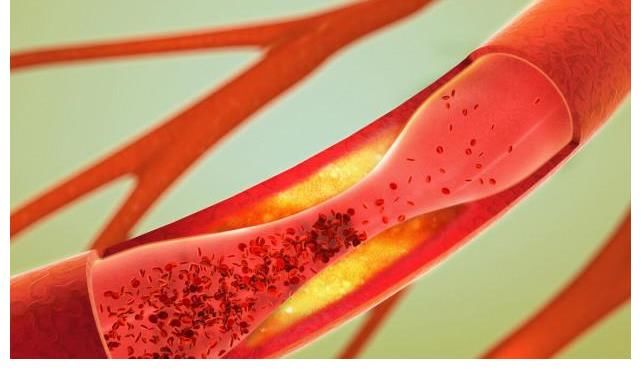 血管|82岁院士提醒:脑供血不足的人,少吃3种食物,或能养护血管