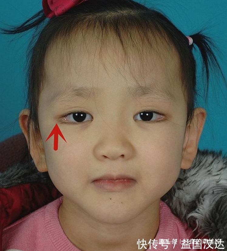 歌舞伎面谱综合征|有一种病叫“孩子太漂亮”,天生自带眼妆,是产检查不出的罕见病