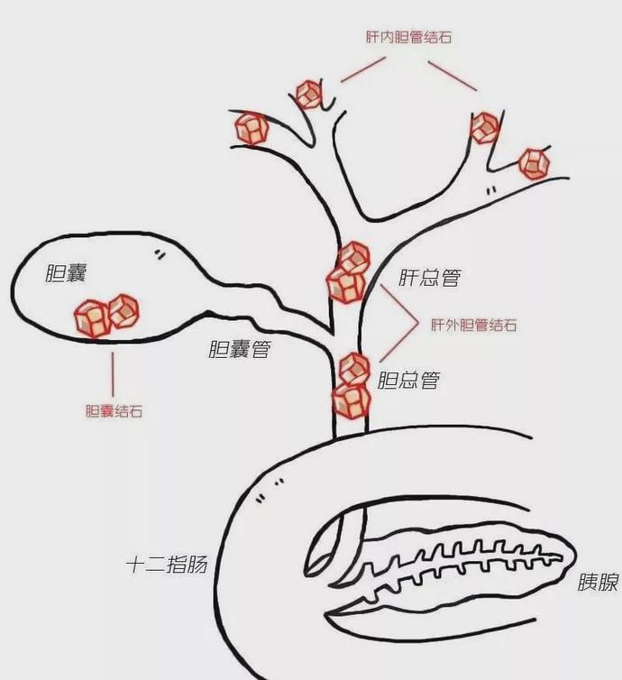 十二指肠|腹痛剧烈竟变“小黄人”，警惕胆总管结石