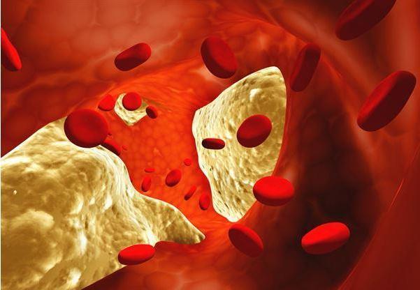 血脂异常|晚上睡觉如果出现以下四种表现,八成是血脂过高,及时去医院检查