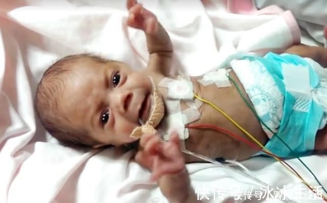 身体|14年过去,原本身体巴掌大“世界最小宝宝”,如今颜值高到认不出