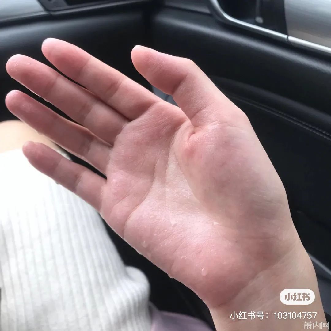 手术|姑娘这个尴尬多年的病症，终于下决心做了手术！经历值得一看