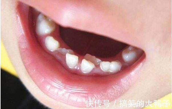 双排牙|6岁孩子长出双排牙,赶紧带去医院检查,得知原因宝妈后悔不已