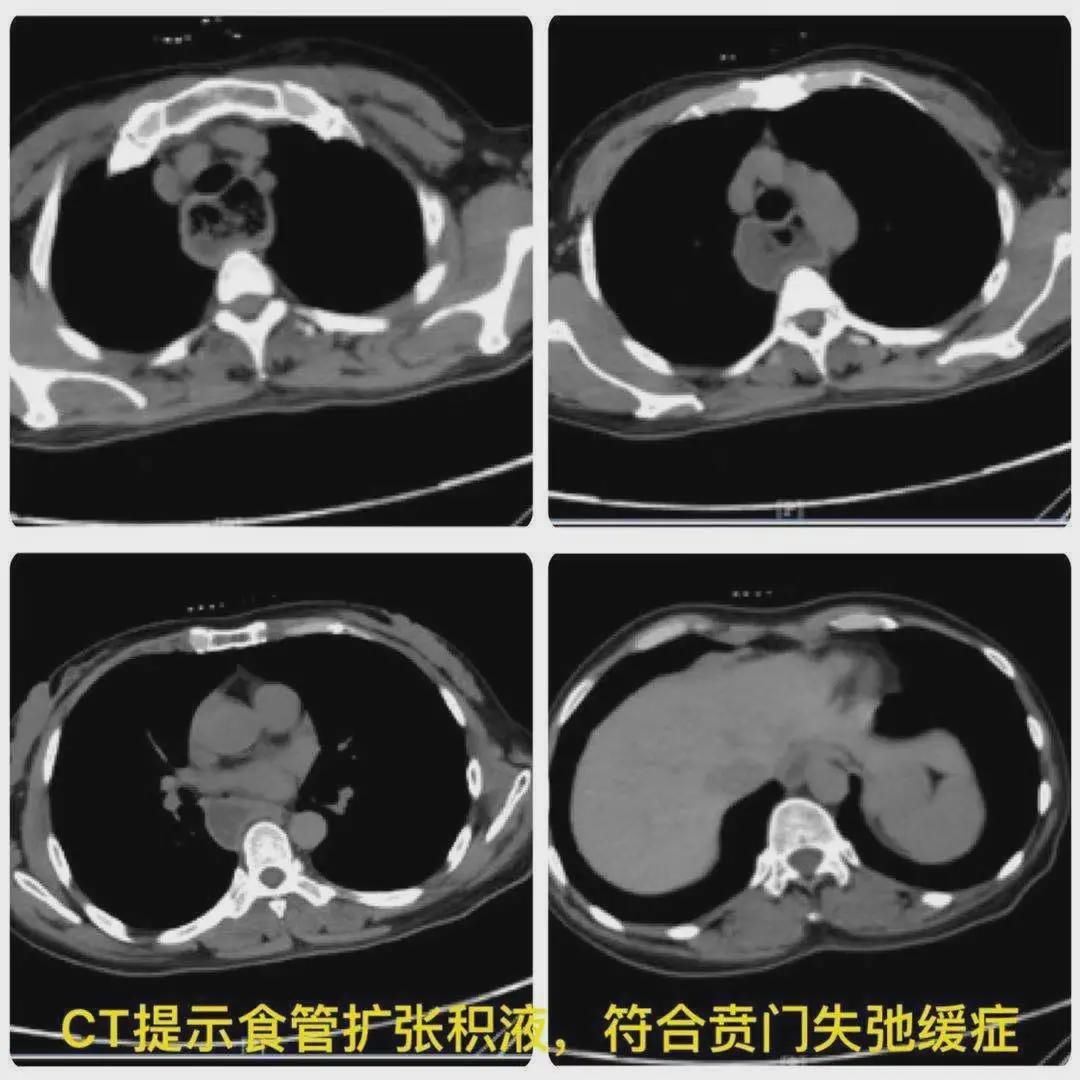 贲门失弛缓症|POEM手术治疗贲门失弛缓症