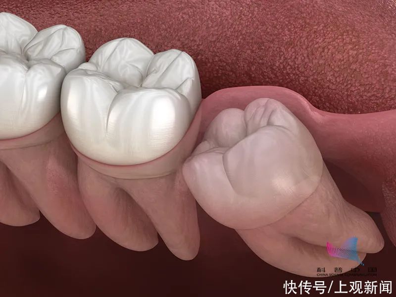 事项|5岁女童拔牙,大出血脑死亡!拔牙前,这些事项一定要知道