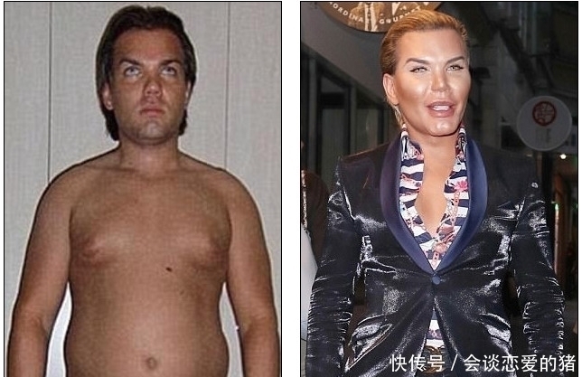 隆鼻|33岁男子整容上瘾,花了百万巨资整容62次,鼻子被整得无法呼吸