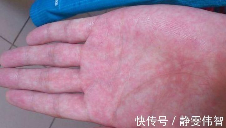 健康|无论男女,如果手上没有这3个“特征”,恭喜你,肝脏还很健康