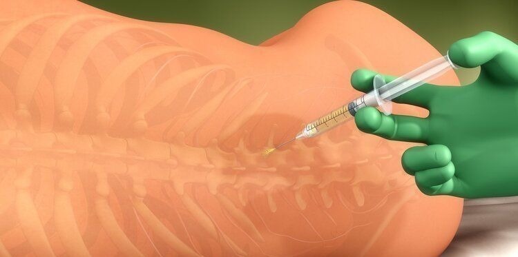 产妇|全麻和半麻有何区别?全麻就是睡了一觉?醒来会变傻、变笨?