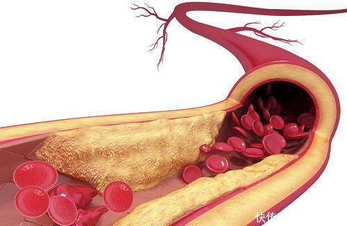 胆固醇|高血脂的人能一天吃一个鸡蛋吗?平时坚持3件事,可有效降低血脂