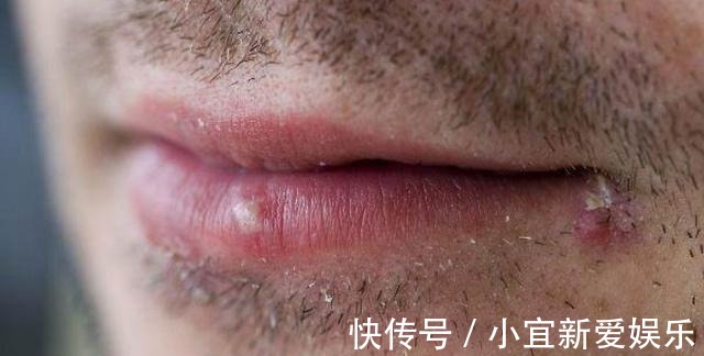 身体|嘴上长泡是身体在排毒吗？或许是暗示了这几个问题，别忽视