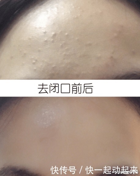 影响|爱挤痘痘的这些女星,现在皮肤都是什么样看这2个例子就知道了